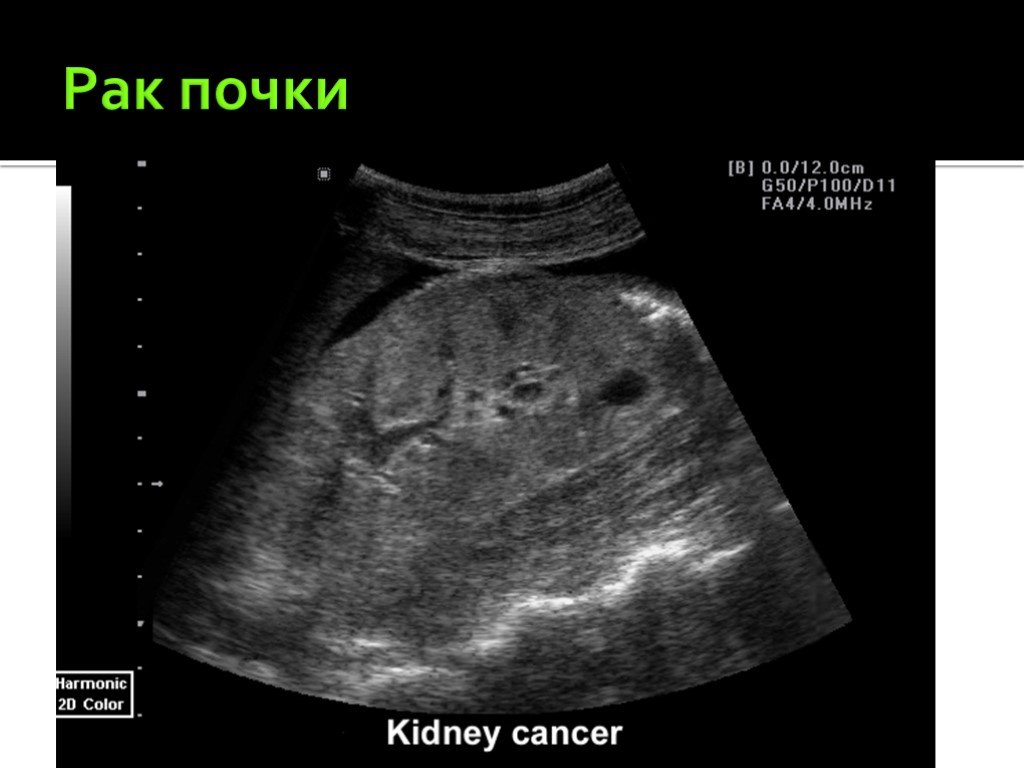 Узи обнаруживает рак. Доброкачественная опухоль почки на УЗИ. Объемное образование в почке на УЗИ что это.