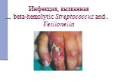 Инфекция, вызванная beta-hemolytic Streptococcus and Veillonella