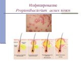 Инфицирование Propionibacterium acnes кожи