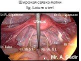 Широкая связка матки lig. Latum uteri