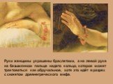Руки женщины украшены браслетами, а на левой руке на безымянном пальце надето кольцо, которое может трактоваться как обручальное, хотя это идёт в разрез с сюжетом древнегреческого мифа.
