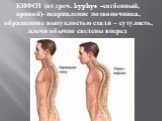 КИФОЗ (от греч. kyphys –согбенный, кривой)- искривление позвоночника, обращенное выпуклостью сзади – сутулость, плечи обычно сведены вперед