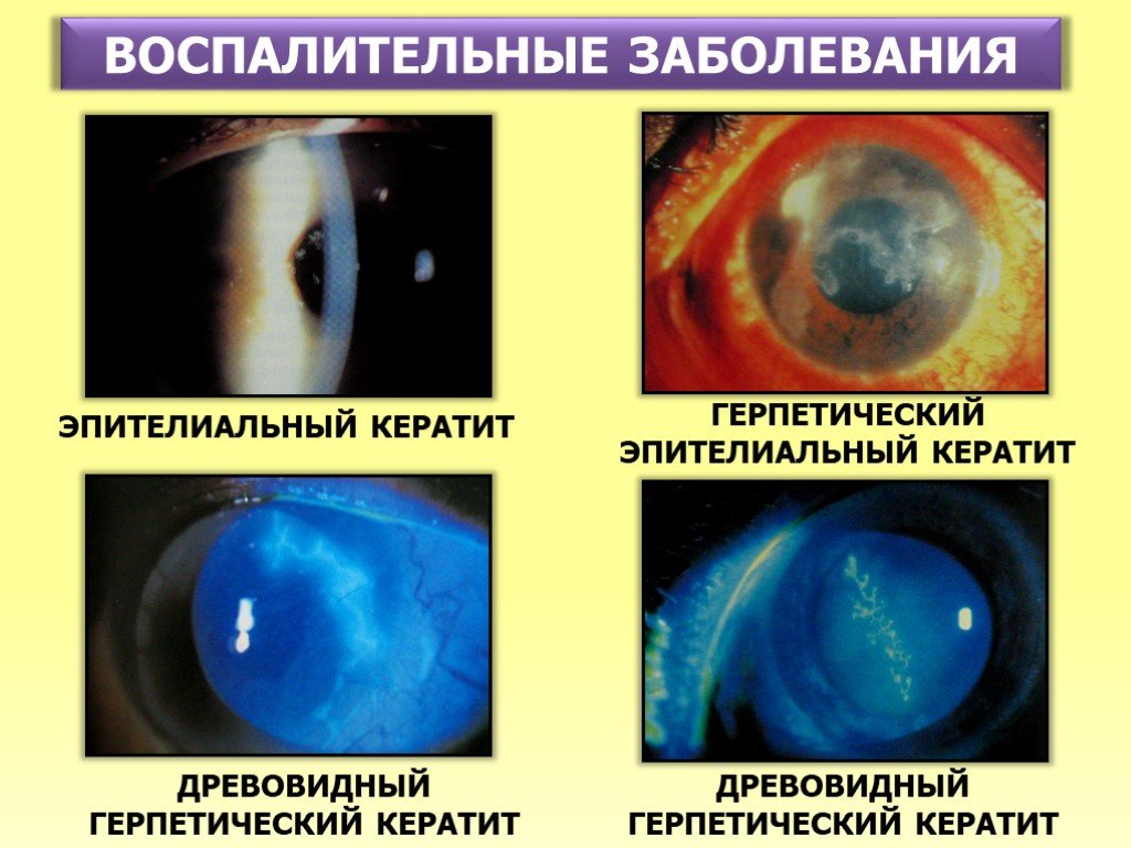Вирусное заболевание глаз. Везикулезный герпетический кератит. Древовидный кератит этиология. Бактериальный кератит роговицы. Кератиты офтальмология.