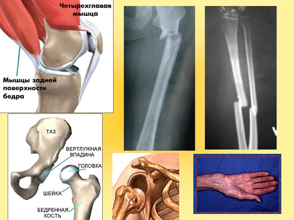 Вывих сустава закрытый перелом разрыв сухожилия. Переломы и растяжения для презентации.