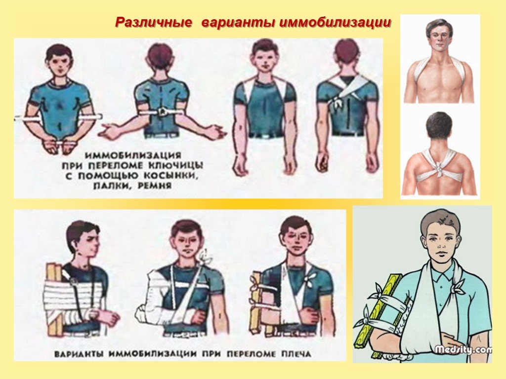 Первая помощь при травмах растяжении связок вывихах суставов переломах костей 8 класс презентация