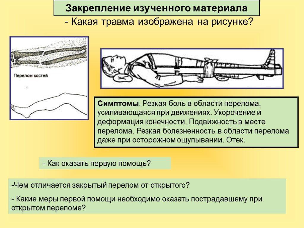 Какая травма изображена на рисунке. Меры первой помощи при открытом переломе. Первая при закрытом переломе биологии. Тип несчастного случая при переломе. Повреждения при открытом переломе.