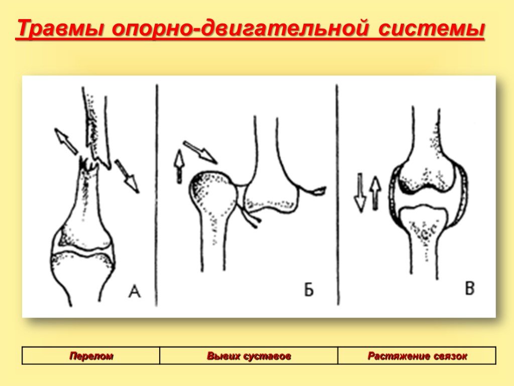 Первая помощь при повреждении скелета