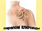 перелом ключицы