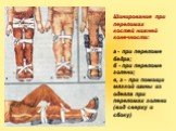 Шинирование при переломах костей нижней конечности: а - при переломе бедра; б - при переломе голени; в, г - при помощи мягкой шины из одеяла при переломах голени (вид сверху и сбоку)