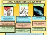 Виды повреждения скелета. Растяжение связок. Вывихи Переломы. Боль, отечность тканей, деформация конечности. Нарушение целостности кости. Обездвиживание (иммобилизация). Боль, припухлость сустава, посинение, ограниченность движений из-за боли. Растяжение или разрыв связок при травме сустава. Мягкая 