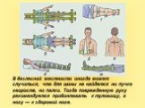 В безлесной местности иногда может случиться, что для шины не найдется ни пучка хвороста, ни палки. Тогда поврежденную руку рекомендуется прибинтовать к туловищу, а ногу — к здоровой ноге.