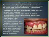 Пародонтит. Пародонтит – это глубокое поражение тканей пародонта на ограниченном участке (2-4 зуба): разрушается связочный аппарат зуба, костная ткань межзубных перегородок. Для пародонтита характерно следующее: заболевают им чаще всего люди в возрасте старше 30-40 лет; на зубах много отложений; дес