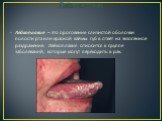 Лейкоплакия. Лейкоплакия – это ороговение слизистой оболочки полости рта или красной каймы губ в ответ на экзогенное раздражение. Лейкоплакия относится к группе заболеваний, которые могут переходить в рак.