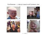 Альбинизм у представителей разных рас. (из ru.wikipedia.org)