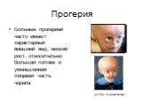 Прогерия. Больные прогерией часто имеют характерный внешний вид: низкий рост, относительно большая голова и уменьшенная лицевая часть черепа. (из http://ru.wikipedia.org)
