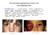 Ретинобластома — злокачественная опухоль эмбриональной сетчатки глаза. Встречается примерно у 1 новорожденного на 15000 — 34000. Типичными являются множественные очаги опухолевого роста на сетчатке. Большинство пациентов погибают от распространения опухоли на ЦНС по зрительному нерву. Заболевание об
