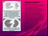 Компьютерная томография дает информацию о степени и протяженности поражения паренхимы легких, о наличии баротравмы или локализованной инфекции. Ранние КТ-исследования легких- локализация легочных инфильтратов носит пятнистый, негомогенный характер, причем существует вентрально-дорсальный градиент ле