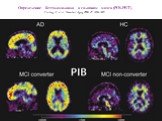 Определение бетта-амилоида а головном мозга (PIB-PET) Forsberg A, et al. Neurobiol Aging 2008; 29: 1456–1465.