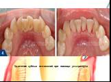 Удаление зубных отложений при помощи ультразвука