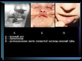А - кожный рог Б - папиллома В - ретенционная киста слизистой железы нижней губы. А Б В