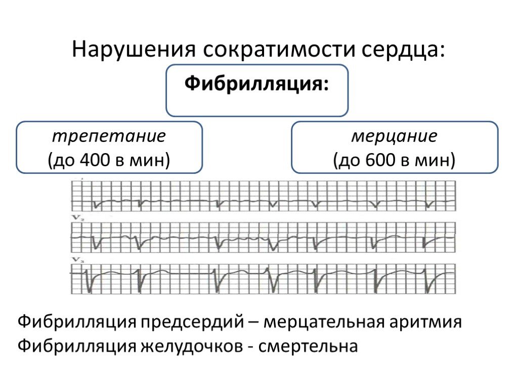 Фибрилляция предсердий картинки