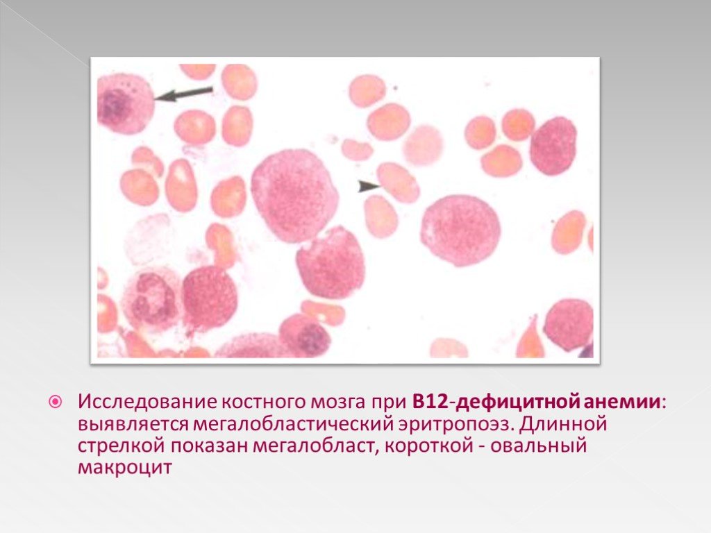 Б 12 исследования. В12-пернициозная анемия. Костный мозг при б12 дефицитной анемии. В12 фолиеводефицитная анемия картина крови. Анемия при в12 дефицитной анемии.