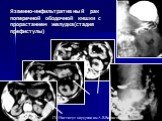 Язвенно-инфильтративный рак поперечной ободочной кишки с прорастанием желудка(стадия префистулы)