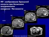 МР- изображение брюшной полости при болюсном внутривенном введении Магневиста. арт вен отср