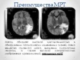 Преимущества МРТ. Метод обладает высокой чувствительностью в обнаружении патологически измененных тканей, отека вещества головного мозга, выявлении плоскостных гематом, а также высокой контрастностью изображения кровоизлияний, невидимых на КТ