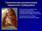 Гематогенная диссеминация первичного туберкулёза. В верхней доле лёгкого под плеврой определяется петрифицированный первичный туберкулёзный аффект (очаг Гона) На разрезе ткани в лёгком множественные мелкие бугорки.