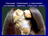 Смешанная (лимфогенная и гематогенная) диссеминация первичного туберкулёза (макро)