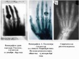 Фотография руки госпожи Рентген, сделанная 22 декабря 1895 года. Фотография А. Колликера сделанная на лекции Вюрцбургского Физико-медицинского общества 23 января 1896 года. Современная рентгенограмма