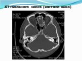 КТ головного мозга (костное окно)