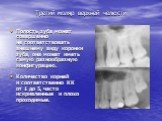 Третий моляр верхней челюсти. Полость зуба может совершенно не соответствовать внешнему виду коронки зуба, она может иметь самую разнообразную конфигурацию. Количество корней и соответственно КК от 1 до 5, часто искривленные и плохо проходимые.