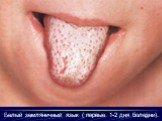 Белый земляничный язык ( первые 1-2 дня болезни).