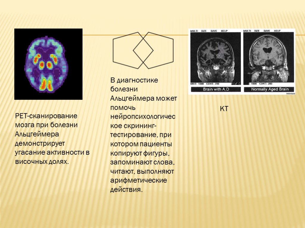 Заболевания мозга диагностика. Выявления болезни Альцгеймера. Мозг при болезни Альцгеймера. ПЭТ сканирование мозга. Болезнь Альцгеймера и пика.