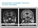Компьютерная томография. Слева мозг с болезнью Альцгеймера