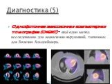 Однофотонная эмиссионная компьютерная томография (ОФЭКТ) – ещё один метод исследования для выявления нарушений, типичных для болезни Альцгеймера. Диагностика (5)