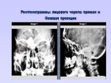 Рентгенограммы лицевого черепа прямая и боковая проекции
