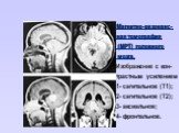 Магнитно-резонанс- ная томография (МРТ) головного мозга. Изображение с кон- трастным усилением 1- сагитальное (Т1); 2- сагитальное (Т2); 3- аксиальное; 4- фронтальное. 1 2 3 4