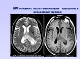 МРТ головного мозга - анапластическая астроцитома в corpus callosum (биопсия)