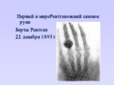 Первый в миреРентгеновский снимок руки Берты Рентген 22 декабря 1895 г