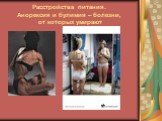 Расстройства питания. Анорексия и булимия – болезни, от которых умирают