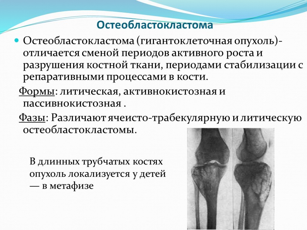 Для рентгенологической картины ячеистой формы гигантоклеточной опухоли характерно