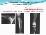 Дифференциальная диагностика остеобластокластомы. Аневризматическая киста. Монооссальная форма фиброзной остеодисплазии длинной трубчатой кости.