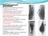 Рентгенологическое исследование: Рентгенологические признаки остеосаркомы (рис.2): -метафизарная локализация в длинных трубчатых костях; -наличие склеротических и литических очагов в кости, наличие васкуляризации; -очаги патологического остеобразования в мягких тканях; -нарушение целостности надкост