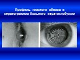 Профиль глазного яблока и кератограмма больного кератоглобусом