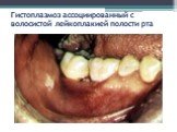Гистоплазмоз ассоциированный с волосистой лейкоплакией полости рта