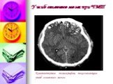Компьютерная томография, показывающая ушиб головного мозга