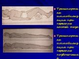 Транспортная иммобилизация при переломе костей таза Транспортная иммобилизация при переломе позвоночника